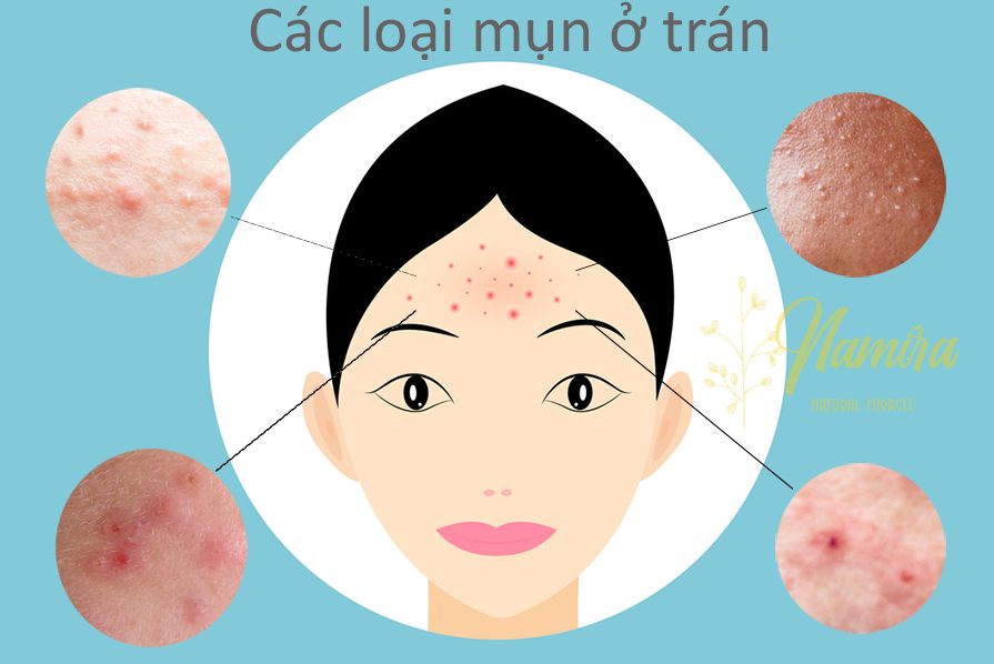 Các loại mụn ở trán