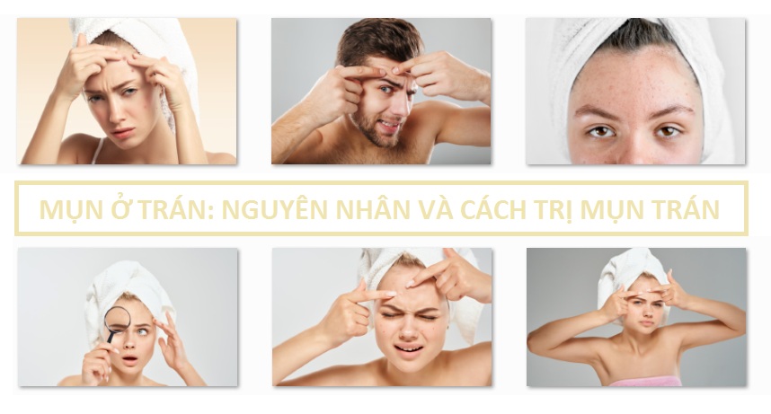 Mụn ở trán: Nguyên nhân và cách trị mụn trán