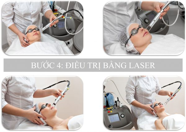 Liệu trình trị nám bằng laser - Bước 4: Điều trị bằng laser