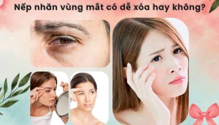 Nếp nhăn vùng mắt có dễ xóa hay không